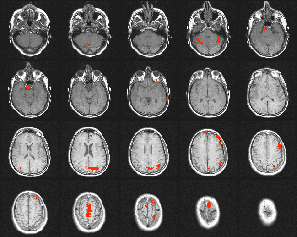 Cerveau dyslexique