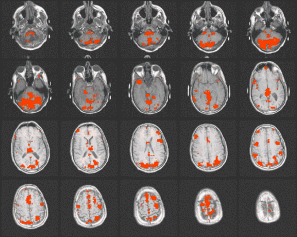 Cerveau dyslexique